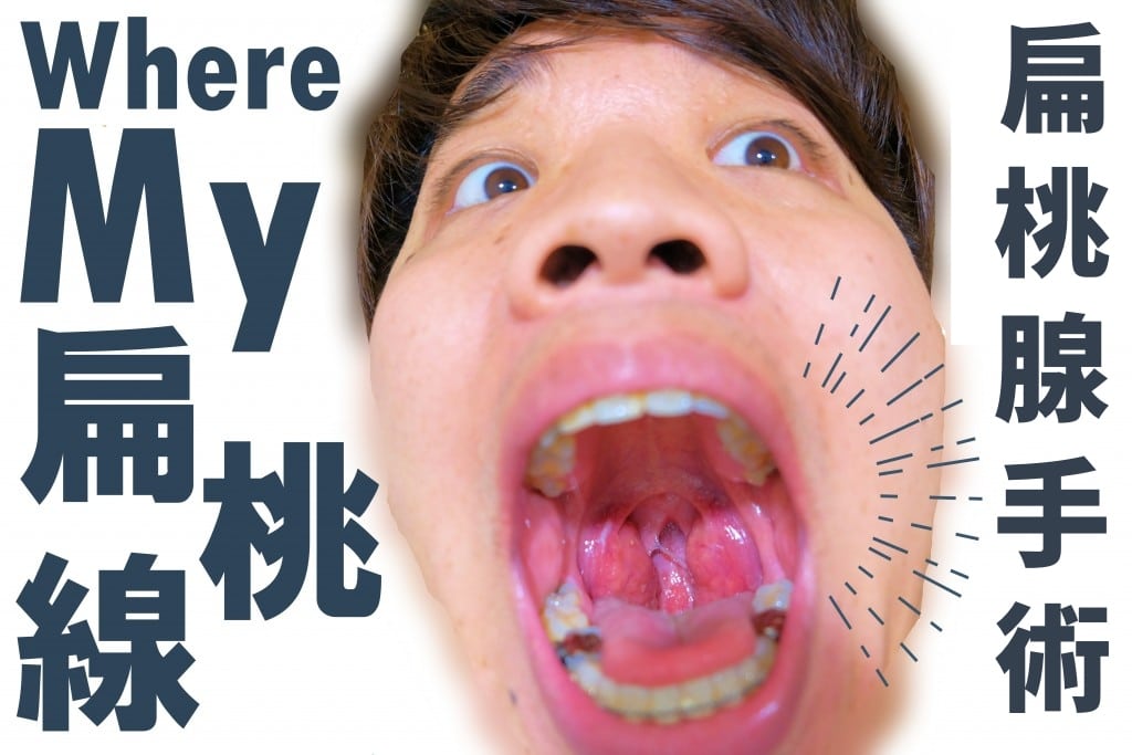 体験レポ】大人の扁桃腺手術後の痛みは?期間は?いびきは治る